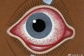 眼睛有红血丝，只是疲劳吗？图片