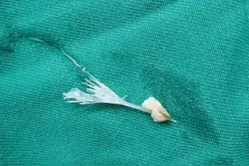 女孩误吞鱼刺 用醋化解却差点刺穿心脏主动脉图片