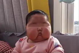 “大头娃娃”能否康复？专家：面部或消肿，但假如错过最佳发育期，错过了就是错过了图片