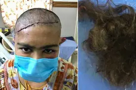 印度女子头皮被意外扯掉 历经10小时手术重新接上图片