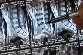 微创治腰突 四天就出院视频封面