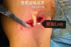 武汉一男子健身后掰手腕，听到“咔”的一声结果悲剧！医生紧急提醒图片