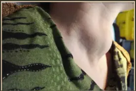 【友谊科普】甲状腺结节微波消融 你问我答图片
