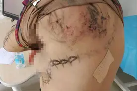 民间说的“蛇缠腰”，缠了一圈就没命？临安大妈在背上画了一道“符”图片