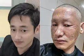 头发直接烧没了图片