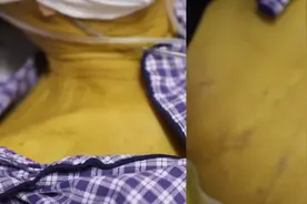 江苏一男子全身变黄似“铜人”，检查发现竟是烟酒惹的祸，医生：险些危及生命视频封面