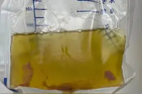 6岁小女孩胸腔抽出500毫升黄色脓液，医生都吃了一惊！这种病拖不得图片