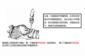用环甲膜穿刺急救有哪些禁忌？医生手把手教你图片