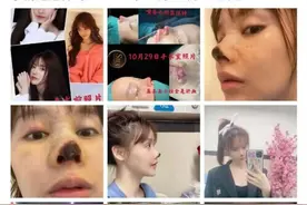 女星自曝整容失败鼻尖坏死 修复手术医生：疑似无菌操作不当造成图片