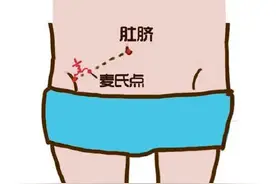 阑尾炎的“疼”是怎样一种感觉图片