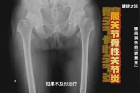 你的髋关节还好吗？3个小测试速来检查图片