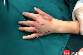 当心！文昌12岁男孩玩鞭炮被炸断5指 医生连续12小时手术才接回图片