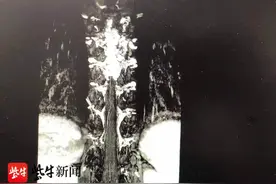 吓人！这种瘫痪可能就在一瞬间，年初三11个小时紧急手术挽救了17岁的她图片
