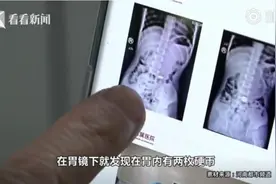 男孩吃饺子吞下2枚硬币，1年后才取出视频封面