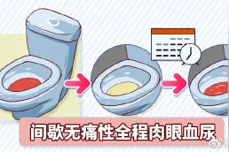 膀胱癌的典型症状是什么？图片