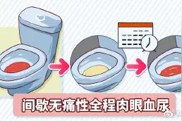 膀胱癌的典型症状是什么？图片