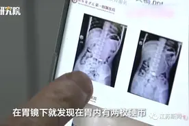 11岁男孩吞下2枚硬币，一年后取出已被严重腐蚀！一问原因网友沸腾了…图片