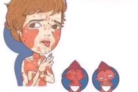 孩子发热、咽喉肿痛、起皮疹可能是这个病惹的祸！视频封面