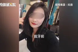 女子连拔3颗智齿肿成松鼠脸 专家称智齿若端正不用拔图片