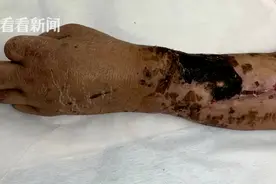 与工友配合失误手腕被切断 3小时断肢再植惊心动魄图片