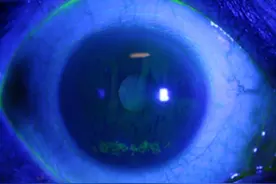 杭州IT小伙眼睛干涩滴眼药水，结果导致角膜损伤……图片