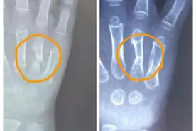体外冲击波治愈骨折伤？看看北京积水潭医院“不流血的手术刀”图片