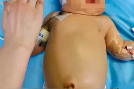 惊心动魄！扬州一“熊猫血”新生儿患溶血症，必须全身换血才有生机……图片