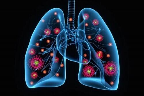 什么是肺部微小结节 2026年肺部微小结节是什么意思严重吗
