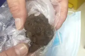 浙江男子喝了两年自制土方药酒，肚子大得像孕妇图片