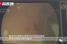 可怕！5岁男童把电池放入嘴里啃咬，结果事儿大了图片