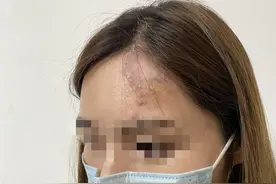 心理培训师注射胶原蛋白美容“毁脸”医院：属小概率并发症 赔偿未达成一致图片