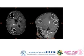 4岁男孩颅内七八个脑脓肿，最大如鸡蛋！新华专家两次“拆弹”转危为安图片