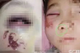 陕西宝鸡一小学生算错题被老师打致结膜出血 涉事教师已停课图片