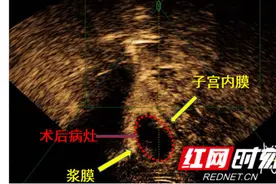 痛经！经量增多！不孕！得了腺肌症怎么办？图片