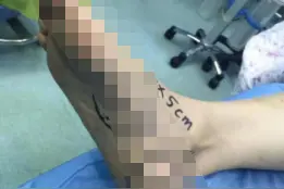 警惕！黑痣突然长大，专家：或是恶性黑色素瘤图片