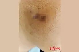 陕西一员工疑似被领导烟头烫脸 办案警官：正在调查中图片