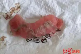 3岁男童误吞牙套致食道穿孔，家长将其倒立，没想到竟口吐鲜血…图片