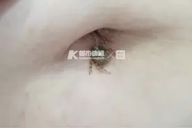 春天来了，小心这个小虫子！昨夜，杭州有医院连着接诊两例蜱虫咬伤图片