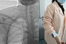 全脑血管造影术是评估脑血管病的金标准，术后患者即刻下地活动图片