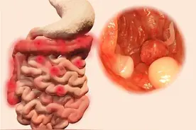 这几个部位长出“息肉”，要及时切除图片