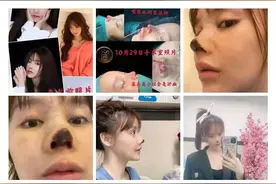 女演员在广州整容失败鼻尖坏死，官方处理结果来了图片