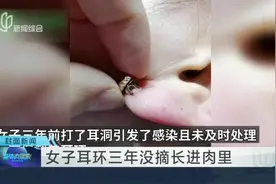 女子耳环三年没摘长进肉里视频封面