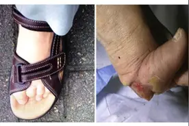得了帕金森病后，足部痉挛怎么办？图片