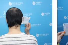 植发仍“头秃”，男子状告倍生植发：因无机构鉴定毛囊存活率败诉图片