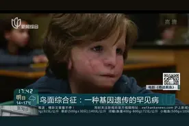 鸟面综合征：一种基因遗传的罕见病视频封面