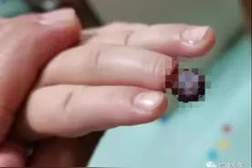 4岁女童玩着橡皮筋睡着了，险些面临截指……图片