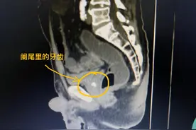 5旬男子肚子里竟有一颗牙！这些东西别乱吞图片