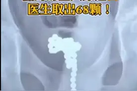 13岁男孩尿道塞入68颗磁力珠，起因只是一时好奇图片