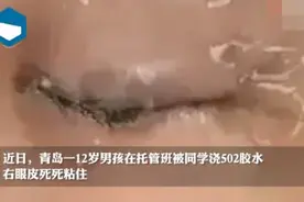 青岛12岁男孩被托管班同学浇502胶水，右眼皮死死粘住！网友怒了图片
