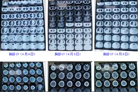 省中医院重症医学科采用中西医结合配合俯卧位通气技术治疗急性脑出血术后伴肺不张疗效显著图片